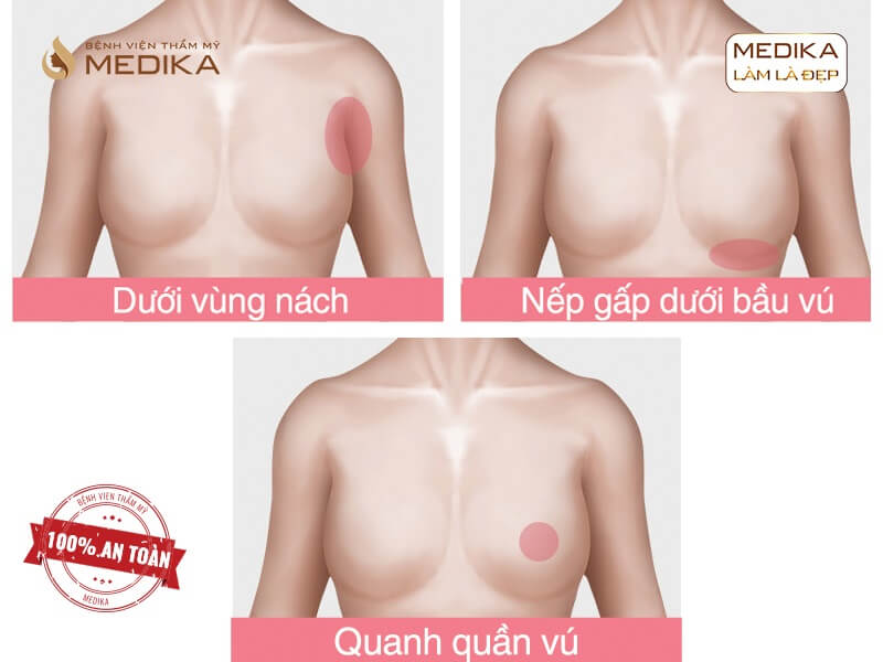 MEDIKA yếu tố lựa chọn địa chỉ xử lý phẫu thuật ngực hỏng ở chuyên gia nâng ngực