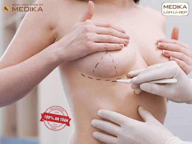 Phẫu thuật chỉnh sửa ngực hỏng yếu tố nào làm nên thành công ở MEDIKA chuyên gia nâng ngực?